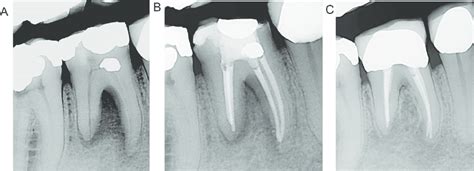 (A) Preoperative radiograph of a case demonstrating apical ...