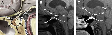 Pituitary Gland Mri