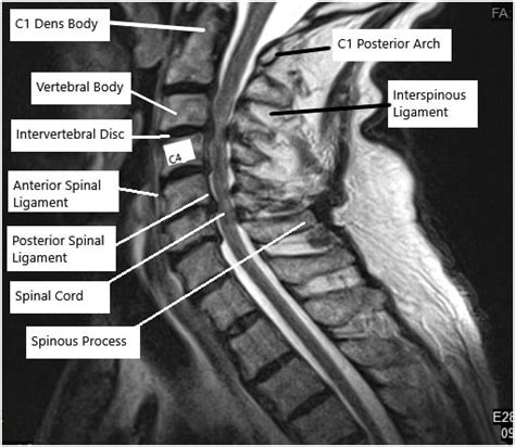 Cervical Spine Surgery - Complete Orthopedics | Multiple NY Locations