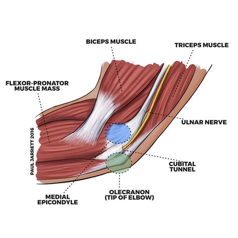 Mr Paul Jarrett | Ulnar Neuropathy at the Elbow / Cubital Tunnel ...