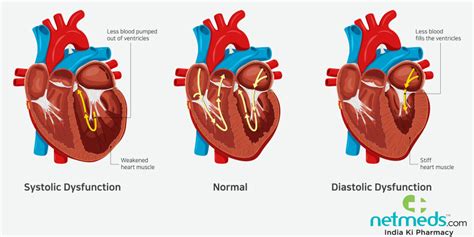 Heart Failure Symptoms, Causes, Types and Treatment