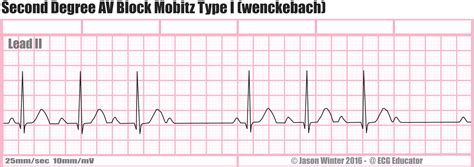 ECG Educator Blog : Second Degree AV Block Mobitz Type I (wenckebach)