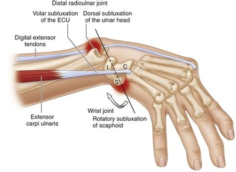 31: Tendon Transfers for Extensor and Flexor Tendon Ruptures | Plastic ...