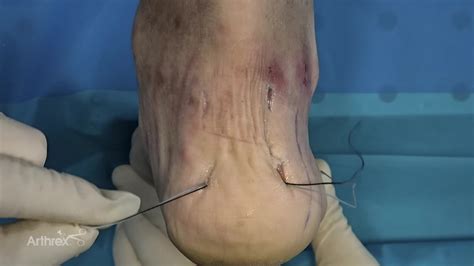 Arthrex - MIS Percutaneous Achilles SpeedBridge™ Surgical Technique