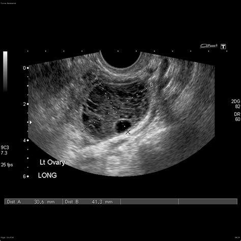 Exploring Sonograms for Ovarian Cysts: Understanding the Role of OB/GYN ...