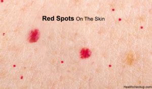 What causes red spots on the skin | How to get rid of the red spots on skin