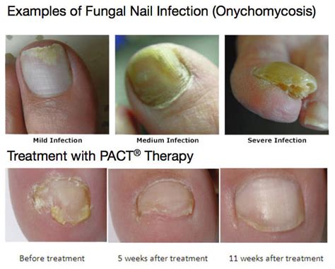 HOW TO TREAT FUNGAL NAIL INFECTION TINEA UNGUIUM, 51% OFF