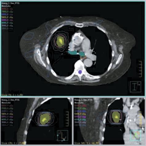 Stereotactic Body Radiation Therapy | Radiology Key