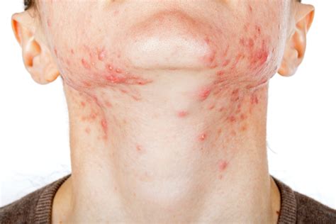 Hormonal Acne: What It Is, Causes, Treatments and Remedies