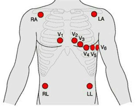 12 Lead Ekg Placement Cheat Sheet