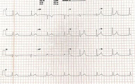 The Two Docs - ECG Quiz!!! ----------------- 30 years old...