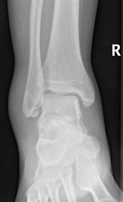 Ankle X-ray - Os subfibulare is an accessory ossicle that lies at the ...