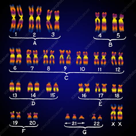 Female Karyotype showing Down's Syndrome - Stock Image C021/9838 ...