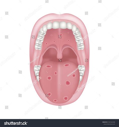 Oral Syphilis Venereal Disease Ulcers On Stock Vector (Royalty Free ...