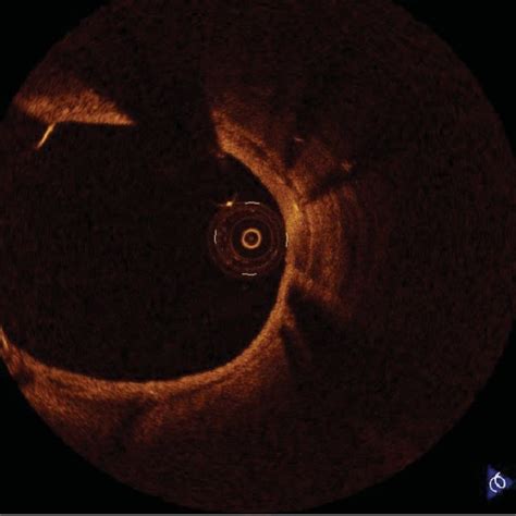 Bare metal stent implanted to the left main-left anterior descending ...