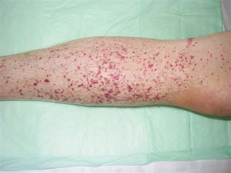 Vasculitis Skin Rash