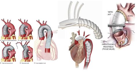 Surgery of the Aorta (Aortic Root, Ascending and Arch of the Aorta ...