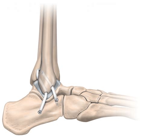 Current Concepts on Subtalar Instability - Bruno S. Pereira, Renato ...