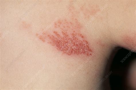 Shingles rash - Stock Image - M260/0313 - Science Photo Library