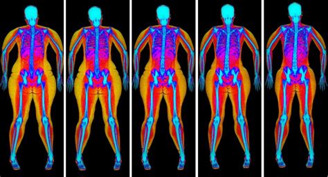 DEXA BODY COMPOSITION ANALYSIS - BGSA Radiology