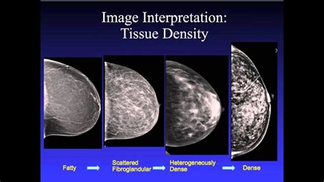 Pin on Health - Mammogram / Abnormal results