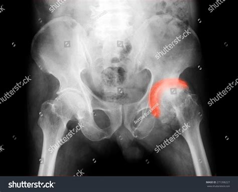 Xray Pelvis Both Hip Joints Ap Stock Photo 271398227 - Shutterstock