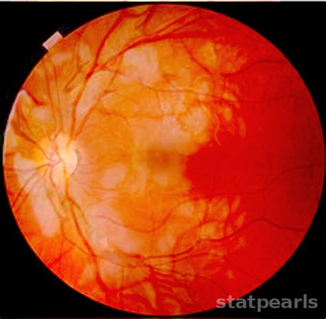 Purtscher Retinopathy Article