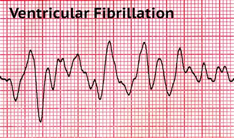 What are the Two Shockable Rhythms in Cardiac Arrest? – Free CPR Training