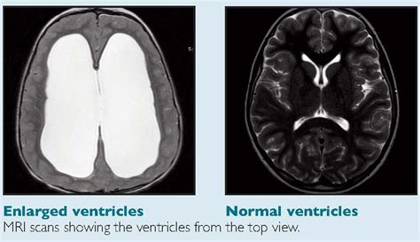 Shunt Systems | Hydrocephalus Association