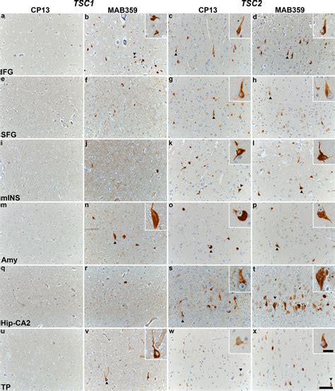 TSC tauopathy is a neurofibrillary tauopathy with prominent tau ...