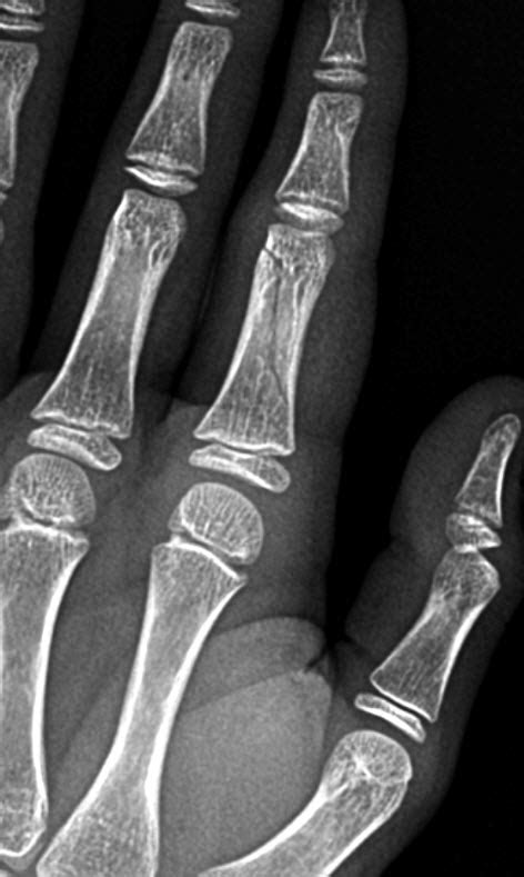 Thumb Proximal Phalanx Fracture