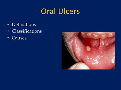 PPT - Ulcers of the oral Cavity PowerPoint Presentation, free download ...