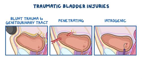 Bladder injury: Clinical sciences - Osmosis Video Library