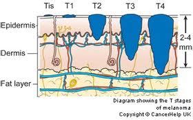 The shave biopsy should be outlawed! | Plastic Surgeon San Francisco ...