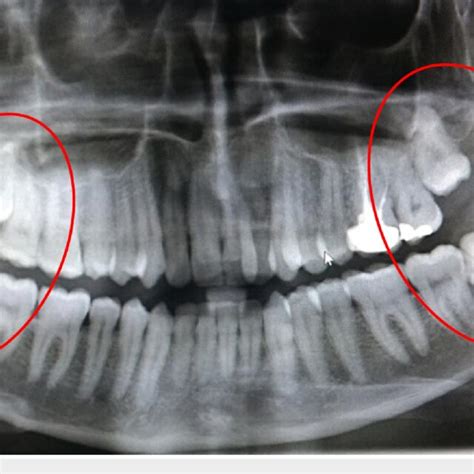 Panoramic radiograph showing radiolucencies compatible with dentigerous ...