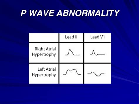 PPT - ELECTROCARDIOGRAMs (ECGs) PowerPoint Presentation, free download ...