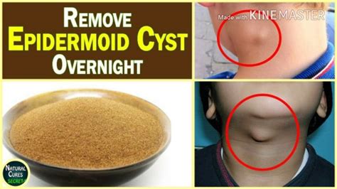 AMAZING!!!Home Remedy To Remove Cysts And Grease Bail Forever In Just 7 ...