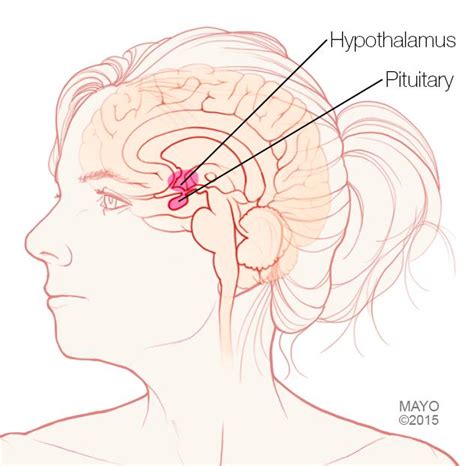 Prolactinoma - Symptoms & causes - Mayo Clinic