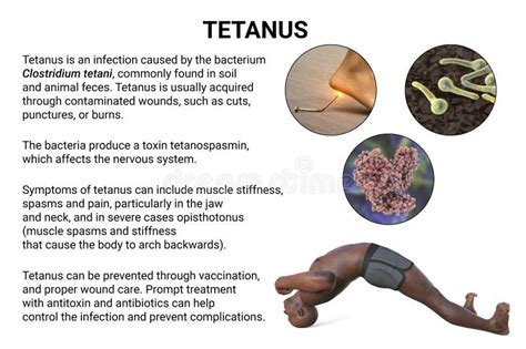 Mechanism of Tetanus Disease, 3D Illustration Stock Illustration ...