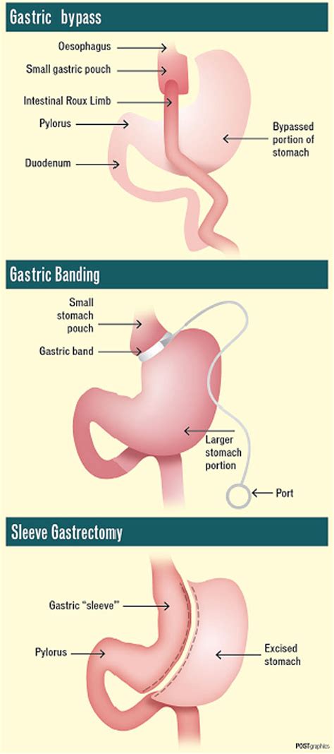 Bangkok Post - Stomach-Churning Choice