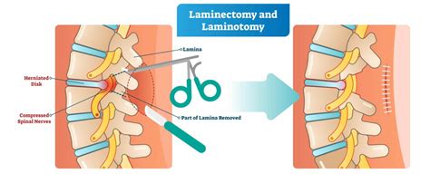 Laminotomy Vs. Laminectomy: What's The Difference? | New Jersey ...