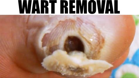 Plantar Wart Removal by Blackhead King | Doovi