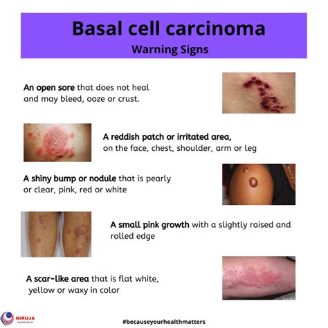 Warning Signs Of Basal Cell Carcinoma