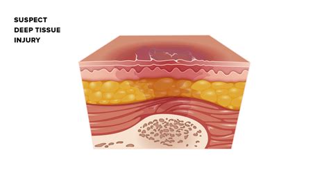 Stages of Pressure Ulcers: Stages, Treatments, and More