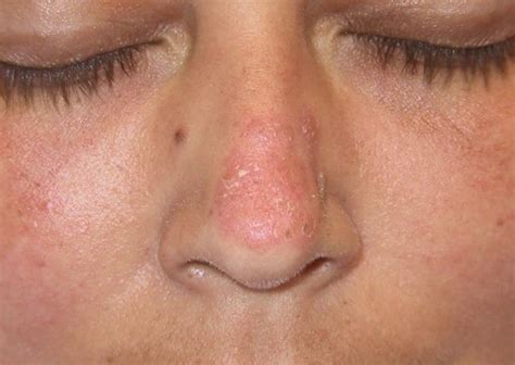 Discoid Lupus - Pictures, Symptoms, Treatment, Causes