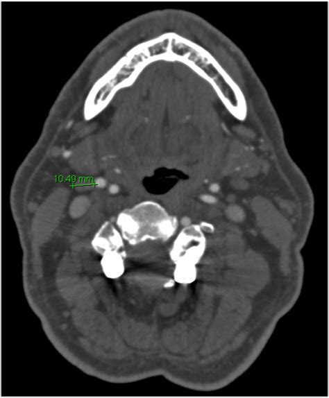 Jugulodigastric lymph node size by age on CT in an adult cancer-free ...