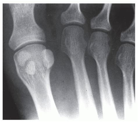 Sesamoid Bone Fracture