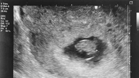 Pregnant Uterus Ultrasound