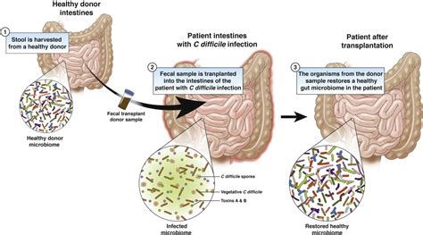 Fecal Transplant: Principle, Procedure, Uses • Microbe Online