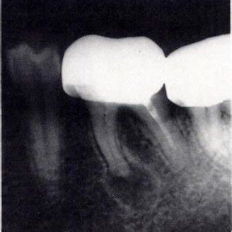 -Periapical abscess. lntraoral radiograph shows mandibular molar with ...